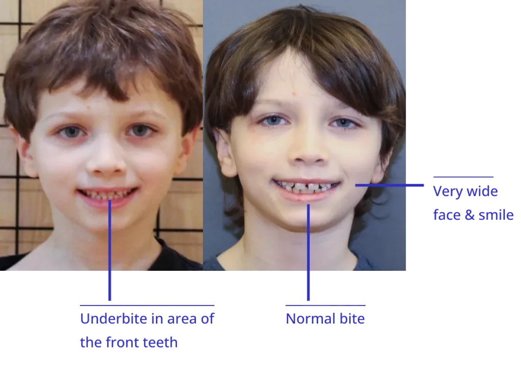The image shows a side-by-side comparison of two individuals with different facial features, likely for illustrative purposes related to cosmetic procedures or personal transformation.