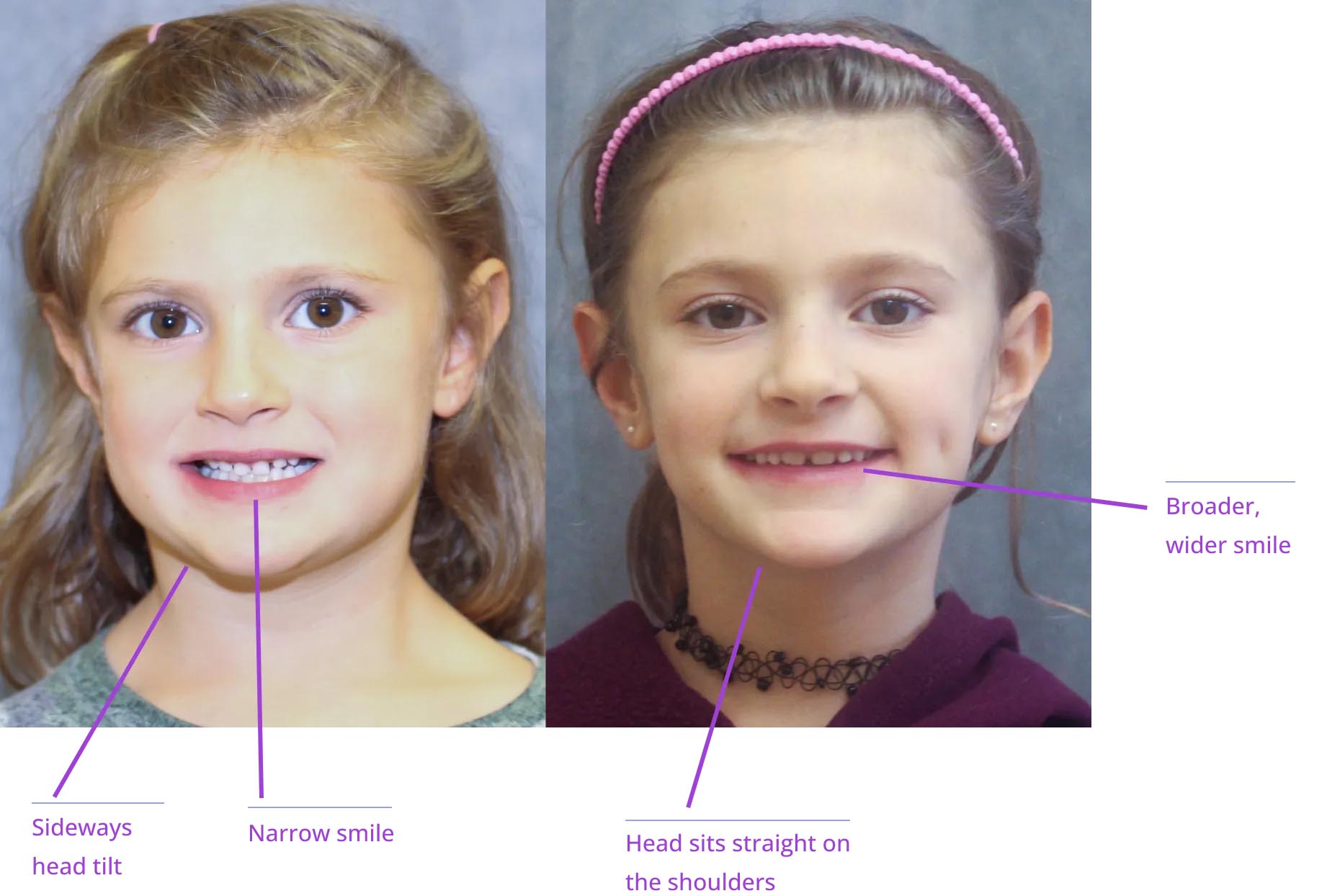 The image shows two children with headshots labeled 'before' and 'after,' highlighting cosmetic dental work, with annotations explaining the treatments provided.