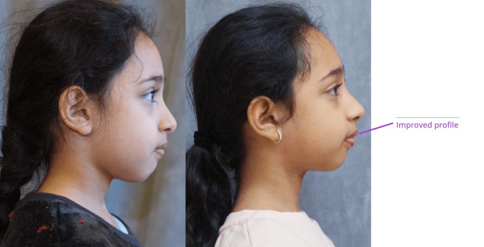 The image shows a side-by-side comparison of two different profiles of a young girl's face, with text pointing out improvements made to her facial profile.