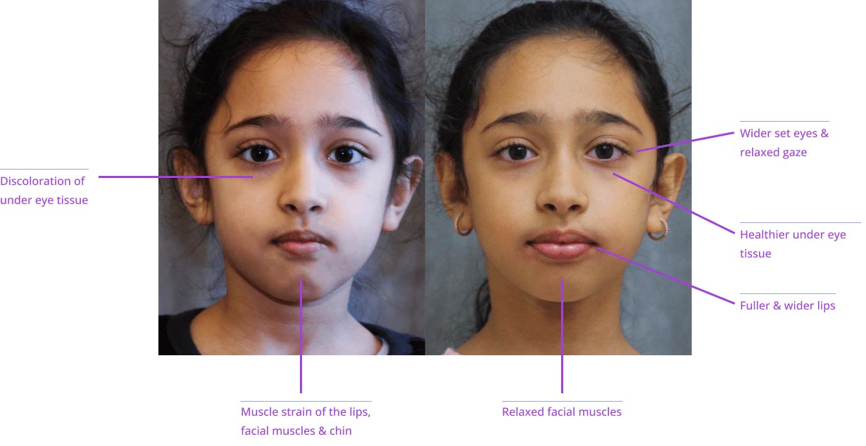The image shows a split-screen comparison of a person's face before and after cosmetic treatments, with annotations indicating facial features and treatment results such as muscle relaxation, wrinkle reduction, and skin tightening.