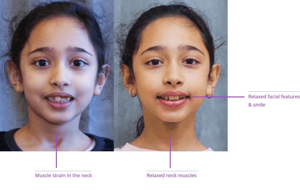 The image shows a side-by-side comparison of two individuals, with labels pointing out facial features such as muscles, neck, and relaxed facial expressions, suggesting an educational context related to human anatomy or health.
