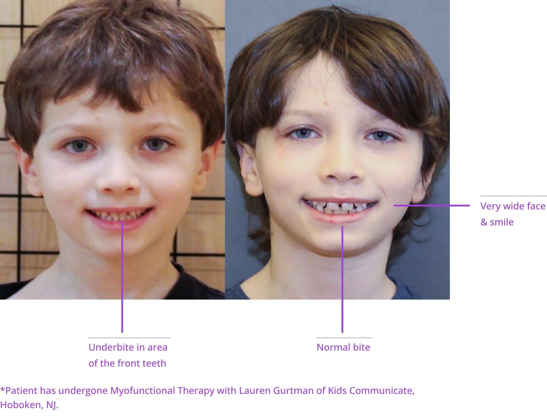 The image shows two side-by-side photographs of a person's face before and after a medical procedure, highlighting the results with annotations pointing out specific features such as teeth alignment, facial symmetry, and skin texture.