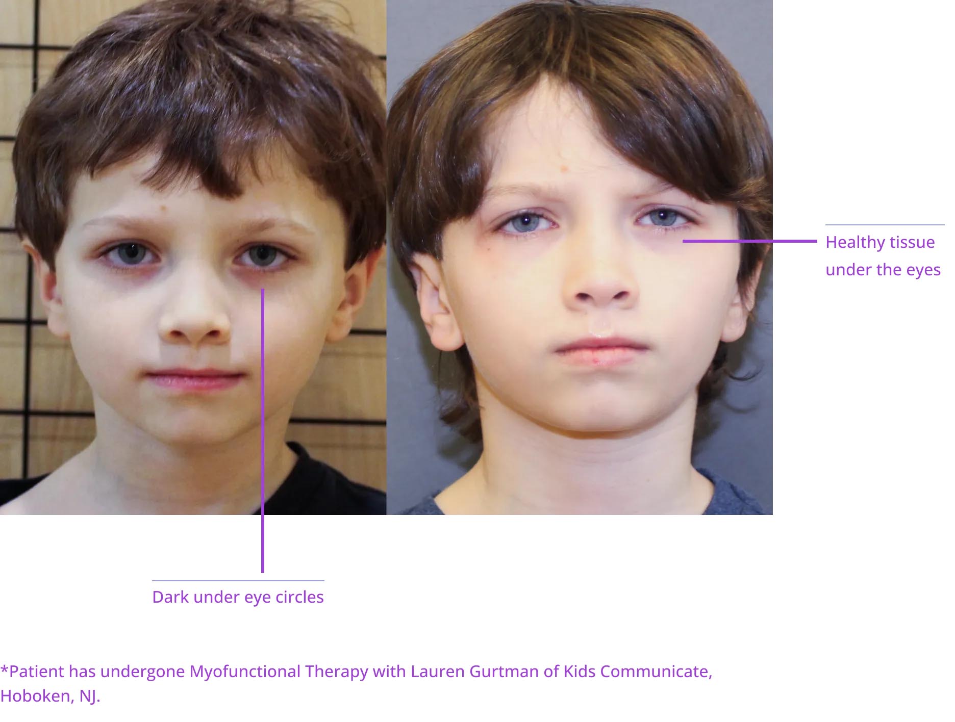 The image shows two before-and-after photos of a person's facial transformation with text annotations indicating cosmetic surgery results, including 'dark under eye circles' and 'patient has dark under eye circles.