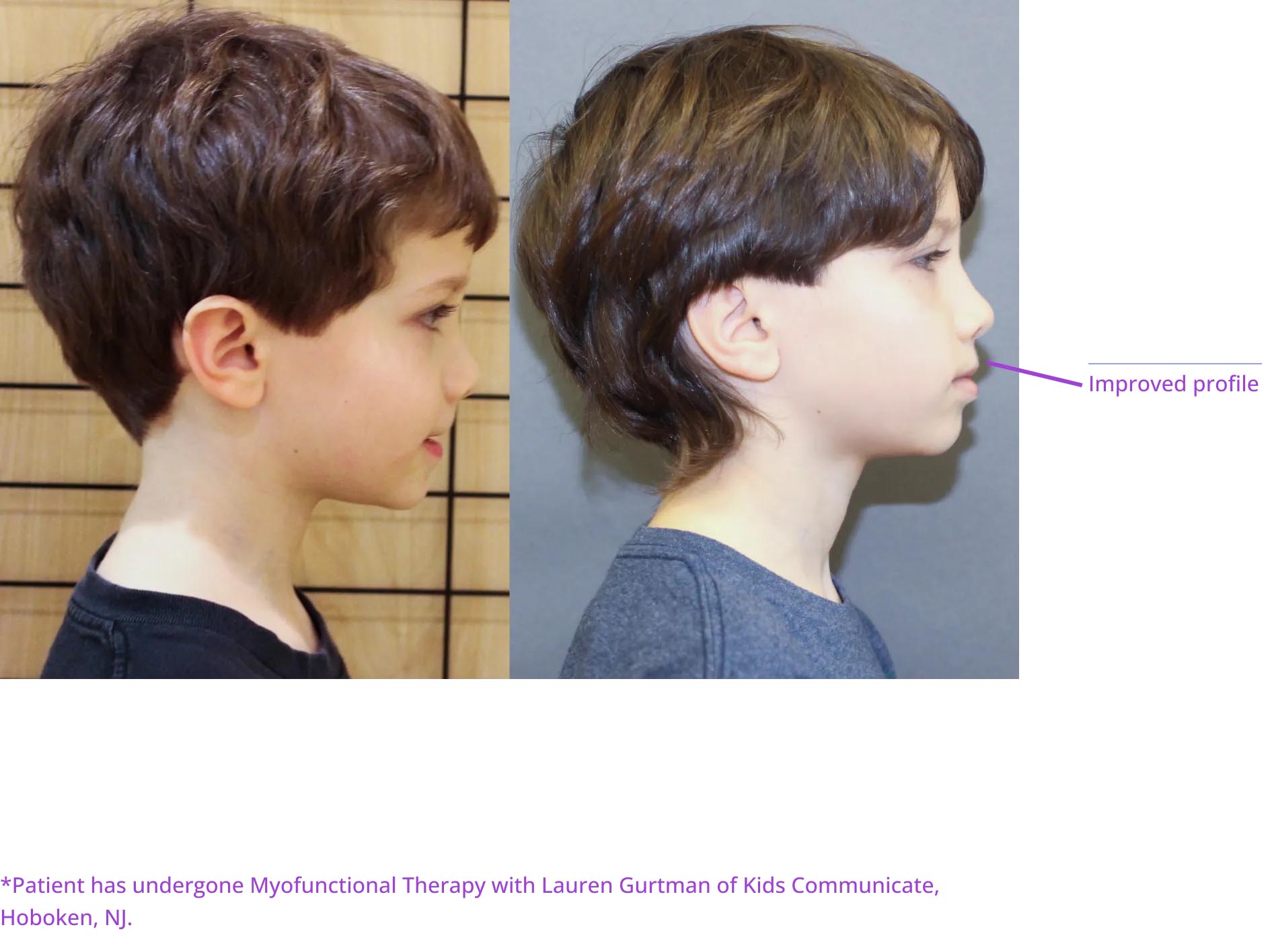 The image shows two photos side by side: on the left, a child with short hair appears before and after what is described as 'my functional therapy with Lauren Gurman of kids Communicates,' and on the right, there's an adult with longer hair, labeled as 'patient has undergone my functional therapy.
