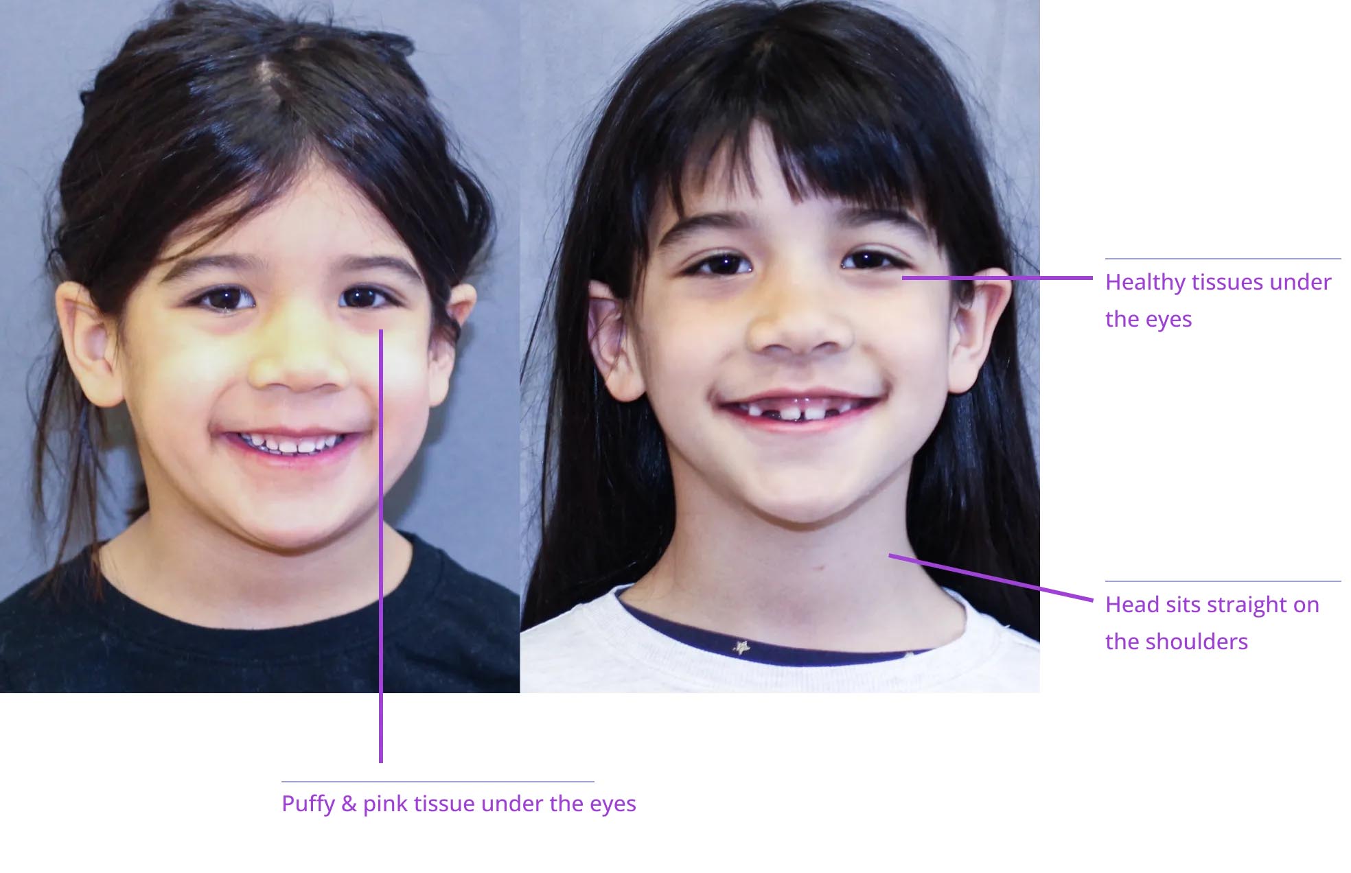 The image shows two children with their eyes closed, labeled with annotations pointing out facial features such as the nose, mouth, and chin.