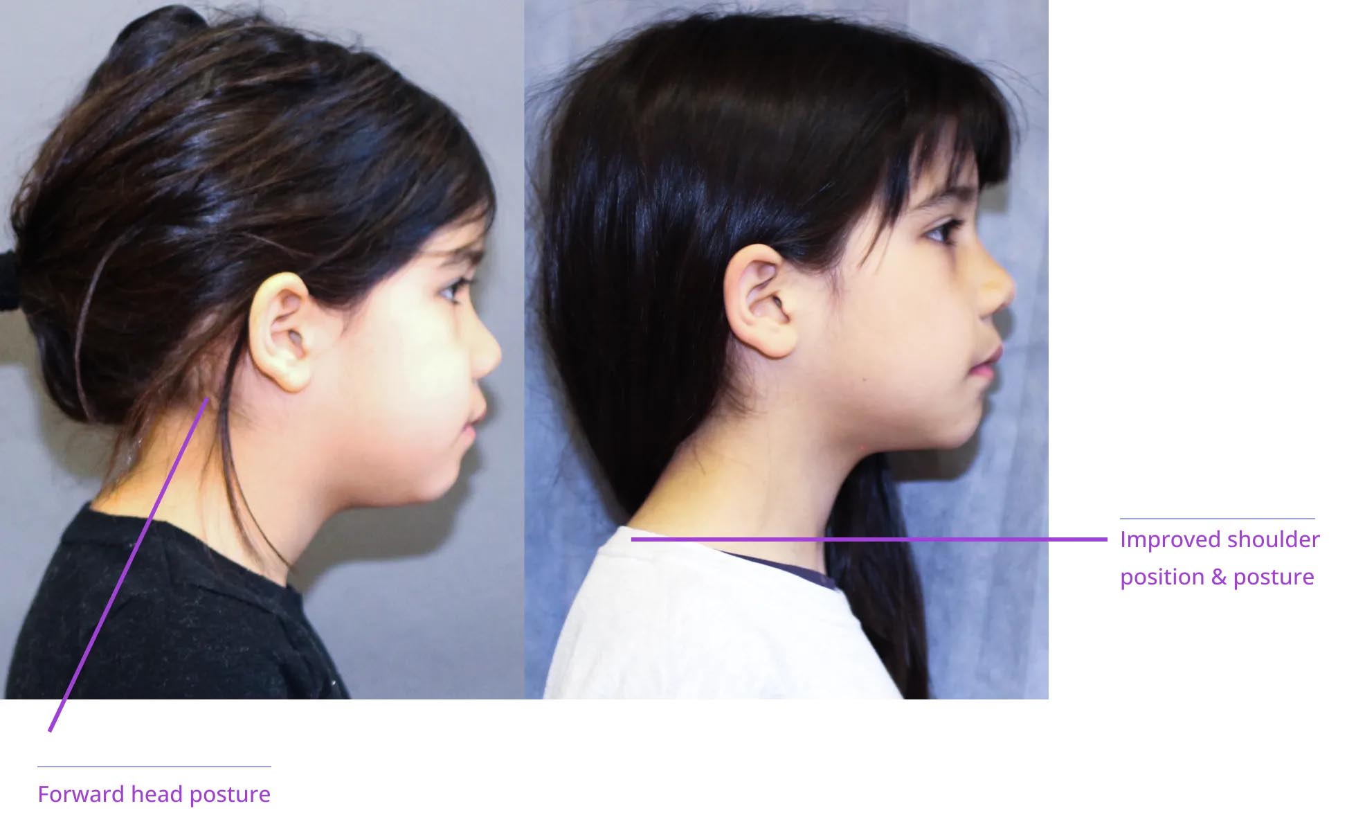 The image shows two side-by-side photographs of a person's profile with annotations pointing out areas of improvement, such as posture and head positioning.