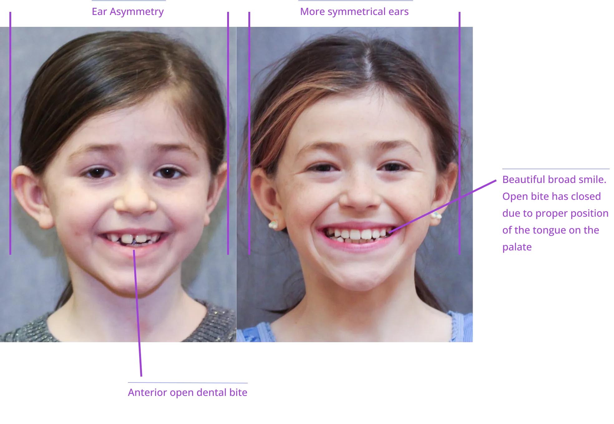 An educational diagram showing two facial expressions with annotations detailing the differences between them, including 'ear asymmetry,' 'smile,' 'beautiful bread,' and 'open dental bite.
