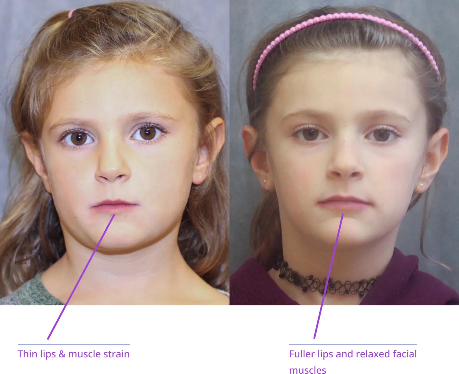 The image shows two photos side by side: on the left, a young girl with a neutral expression; on the right, an adult woman with a similar expression, both highlighting facial features such as lips, cheeks, and neck muscles, with labels indicating 'thin lips & muscles' and 'fuller lips & muscles.