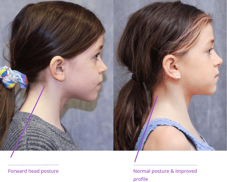 The image shows two side-by-side photographs of a person's head and neck from different angles with annotations indicating 'forward head posture' and 'normal profile.