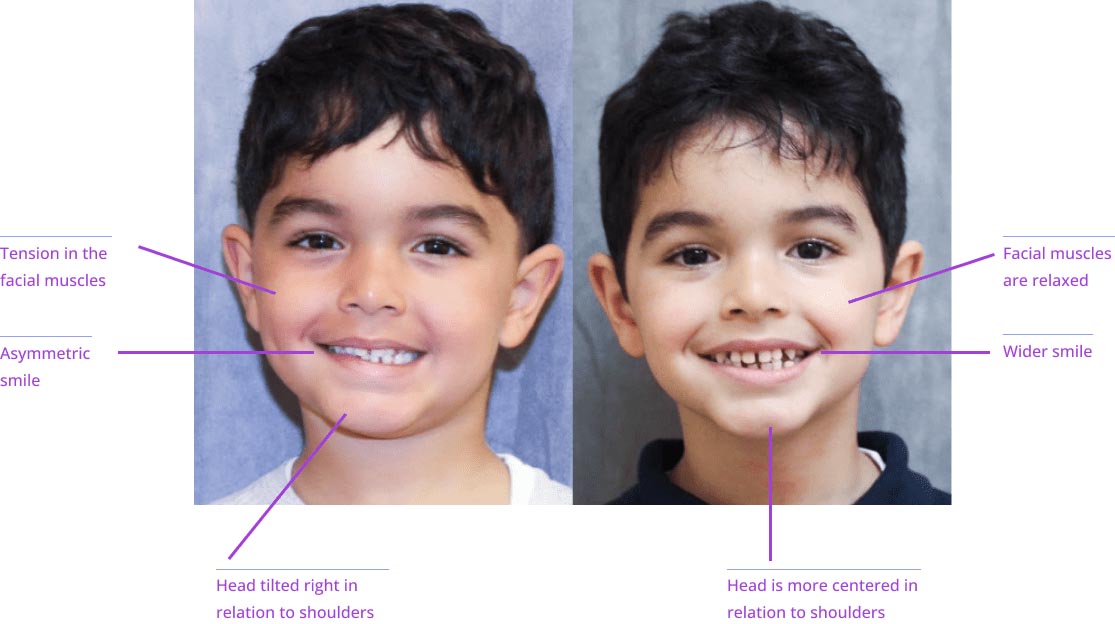 The image shows two side-by-side photographs of a young boy's face with annotations indicating different facial features such as eyes, nose, mouth, and other details, suggesting a focus on human anatomy or comparison between the two images.