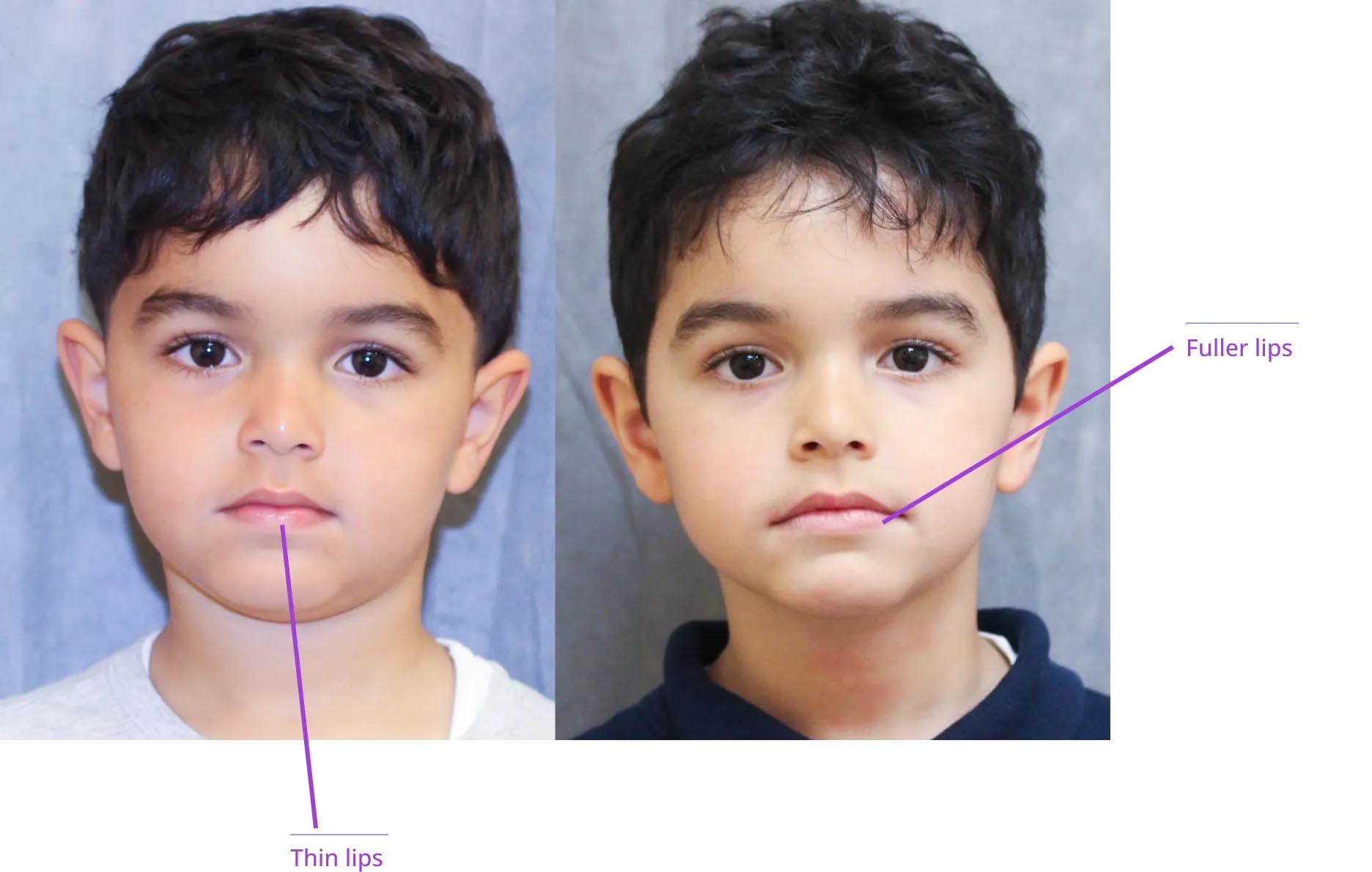 The image shows two side-by-side photographs of a child's face with annotations indicating cosmetic surgical procedures, such as nose reshaping and chin enhancement.