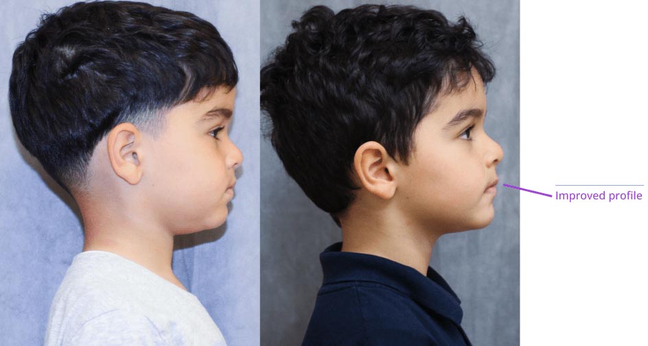 The image shows a split-screen comparison of a person's profile from two different angles, highlighting the transformation from a younger state to an older one, with a focus on facial features and hairline changes.