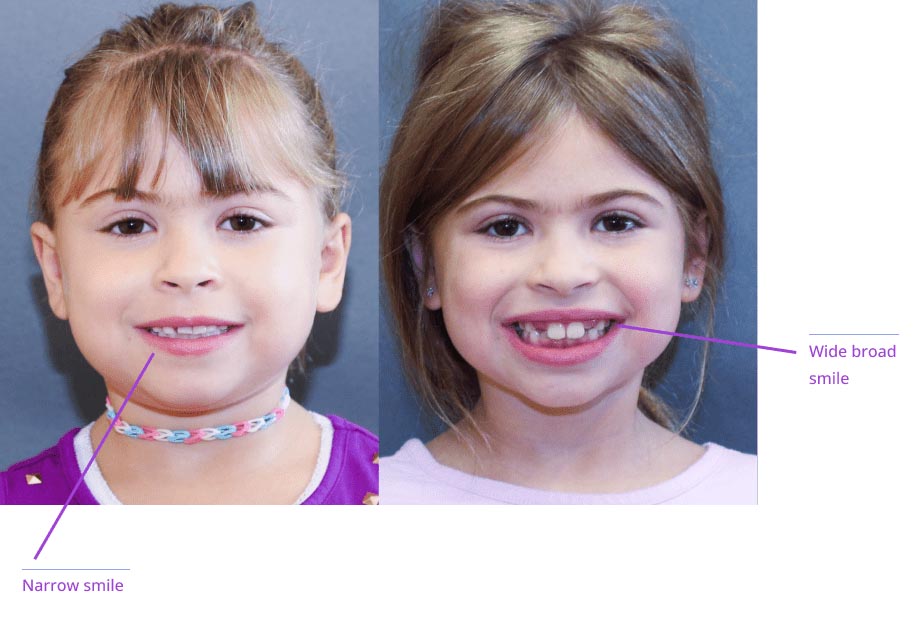 The image shows two young girls with smiling expressions, each with a different hairstyle and facial expression, labeled with text indicating 'narrow smile' on one side and 'wide smile' on the other.