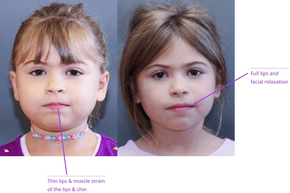 The image shows two photographs of children's faces with annotations pointing out different facial features such as eyes, nose, lips, and chin, along with labels indicating muscle groups like 'train of the lips' and 'muscles of the chin.