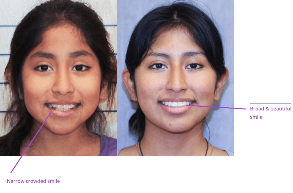 The image shows a before-and-after comparison of a person's facial appearance with cosmetic enhancements, highlighting the results of a smile makeover.