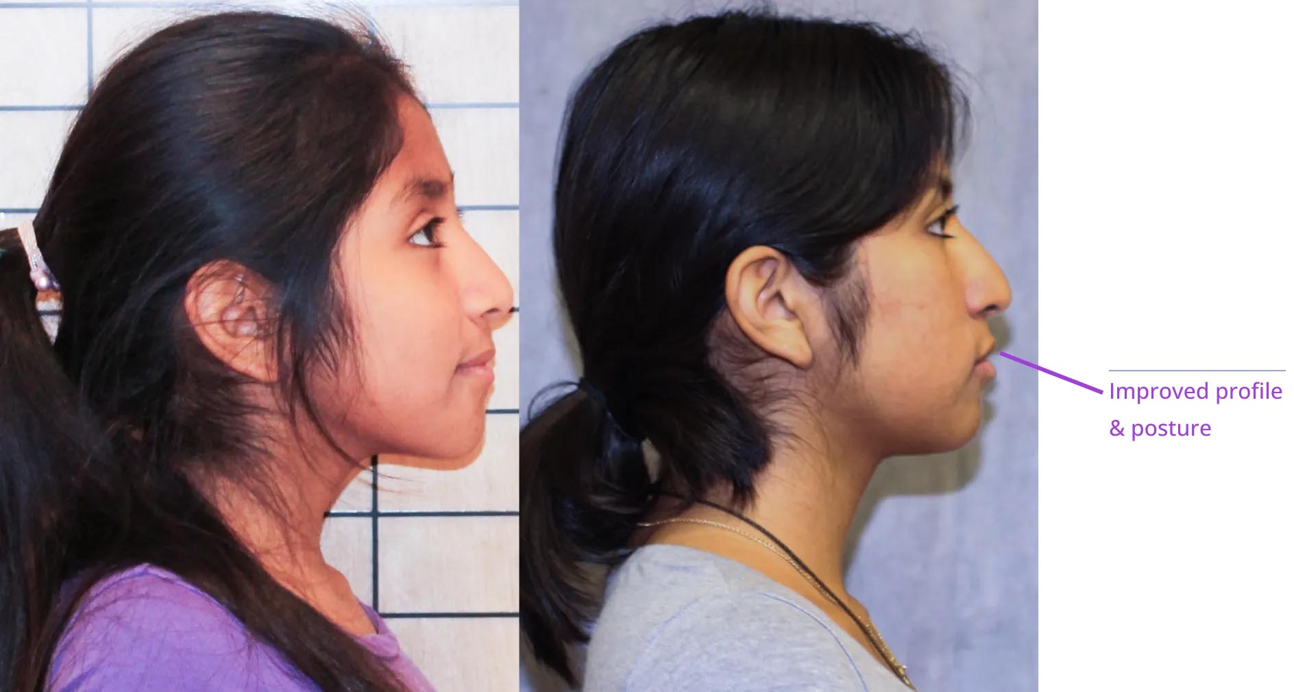 The image displays two side-by-side photographs of a person's profile view with text annotations highlighting improvements in facial features, specifically mentioning the nose and chin.