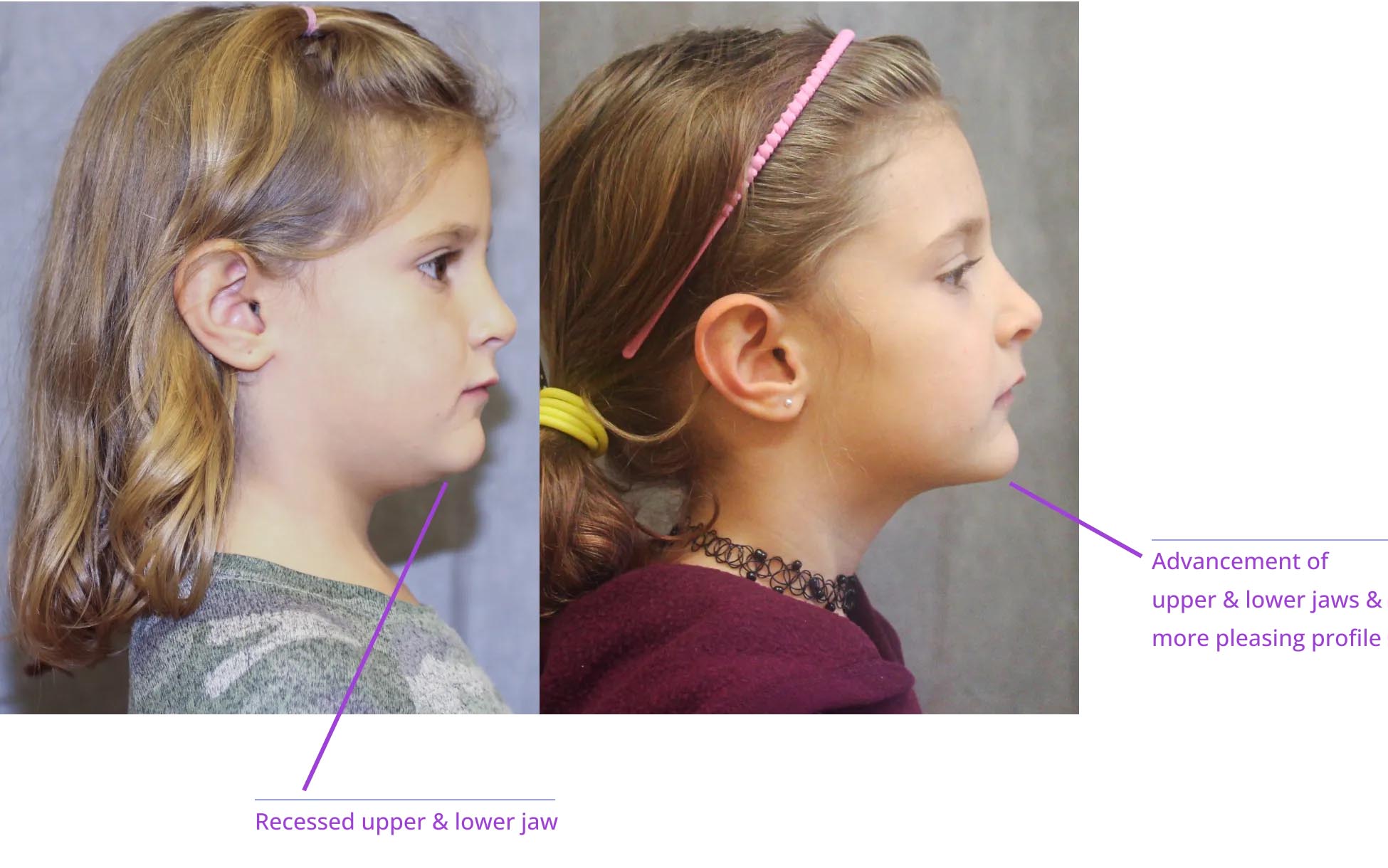 The image shows three photographs of a person's profile view, highlighting different stages of orthodontic treatment with annotations explaining each stage.