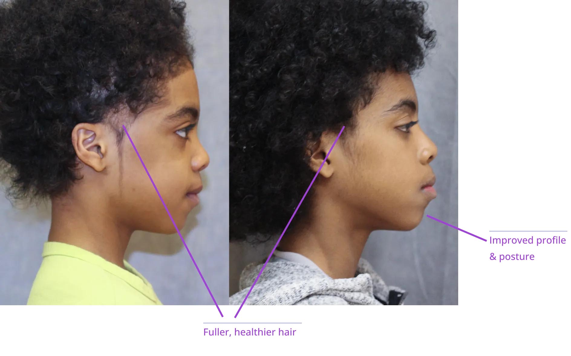 A split-screen comparison showing two different views of a person's face with annotations indicating areas of focus for cosmetic enhancement, such as nose contouring and facial profile adjustments.