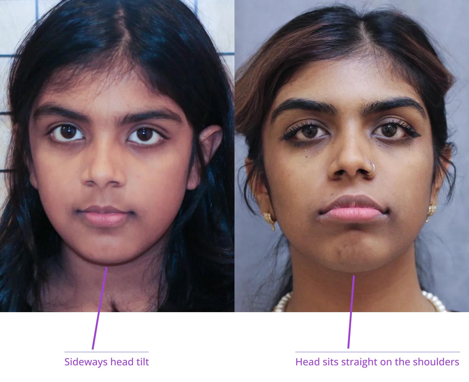 The image shows two side-by-side photographs of a person with text annotations indicating the head's position, 'headways head straight on the shoulders.