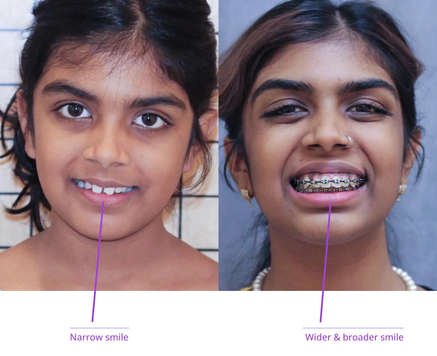 The image shows two photos of a person's smile transformation with annotations indicating narrower teeth and wider smile.