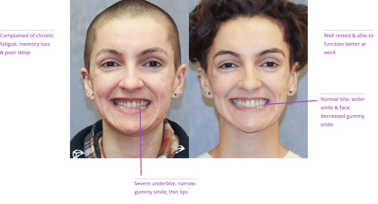 The image displays two side-by-side photographs of a person's face with text annotations pointing out features such as 'complaint of dark circles,' 'normal skin,' 'severe acne,' and 'serious acne.