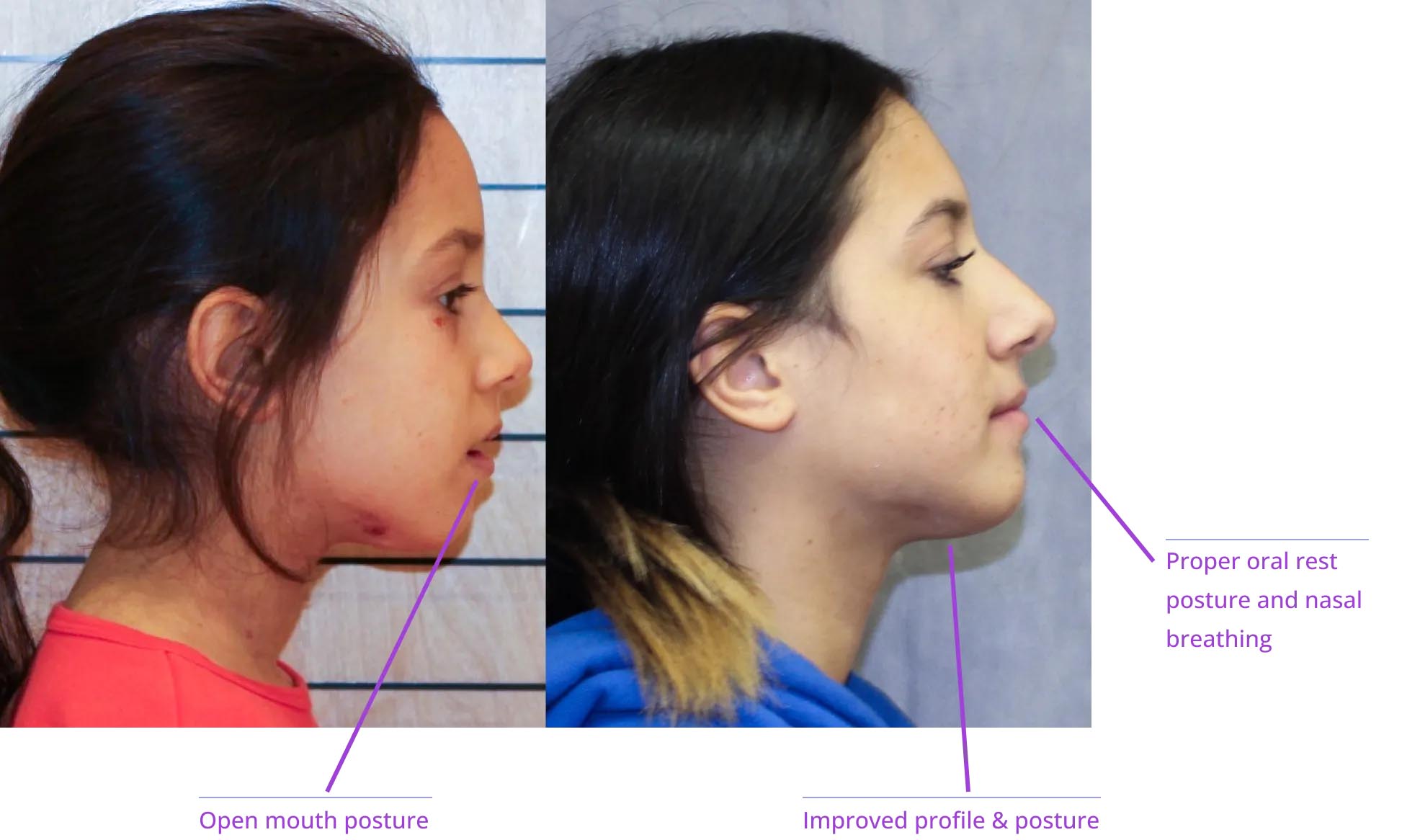 The image shows three photographs of a person's face with annotations indicating facial features and procedures such as open mouth, nose, lips, chin, teeth, tongue, cheek, and neck.