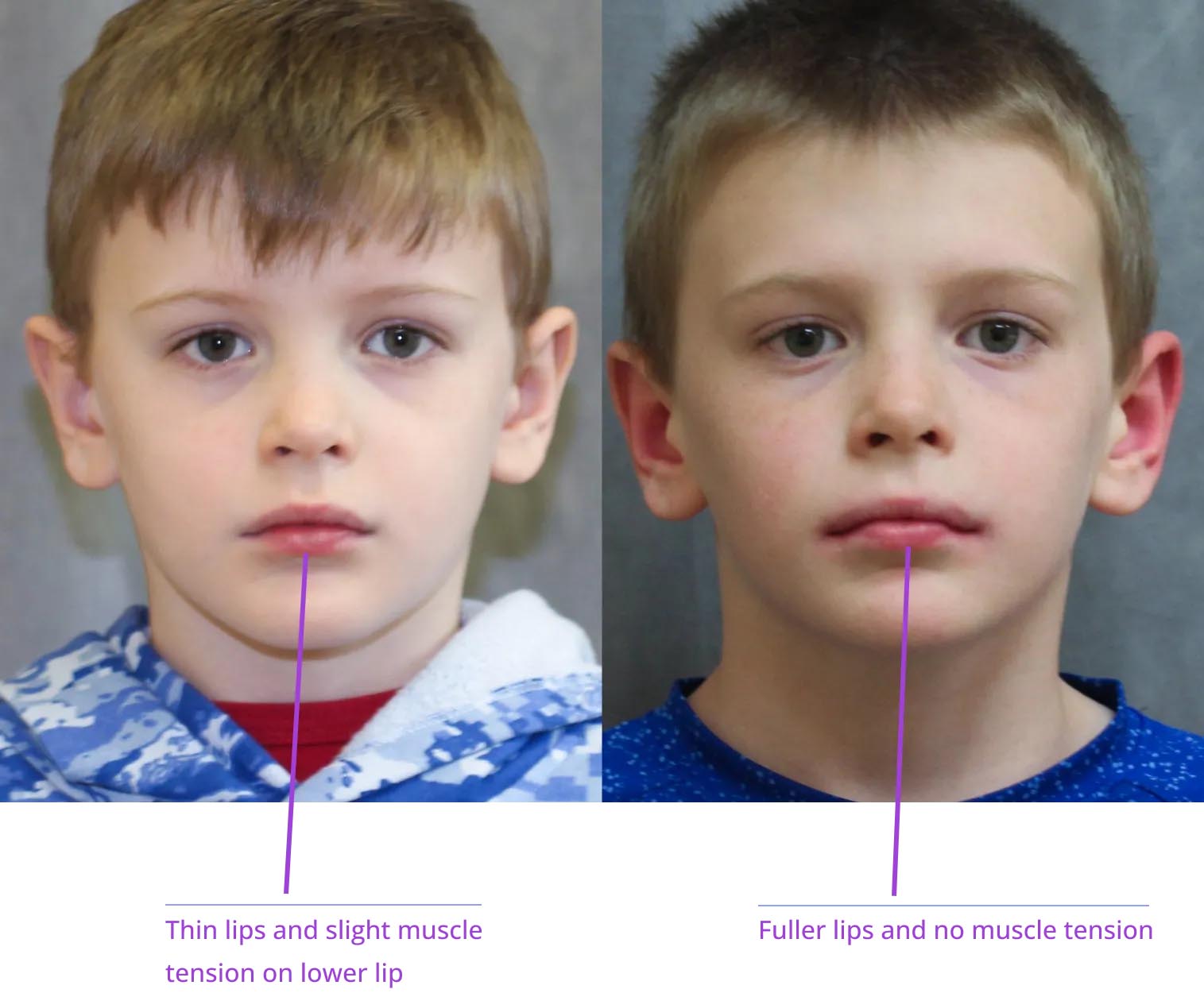 The image shows two young boys with side-by-side close-ups of their facial features, highlighting differences in muscle tone and lip size, accompanied by annotations explaining these variations.