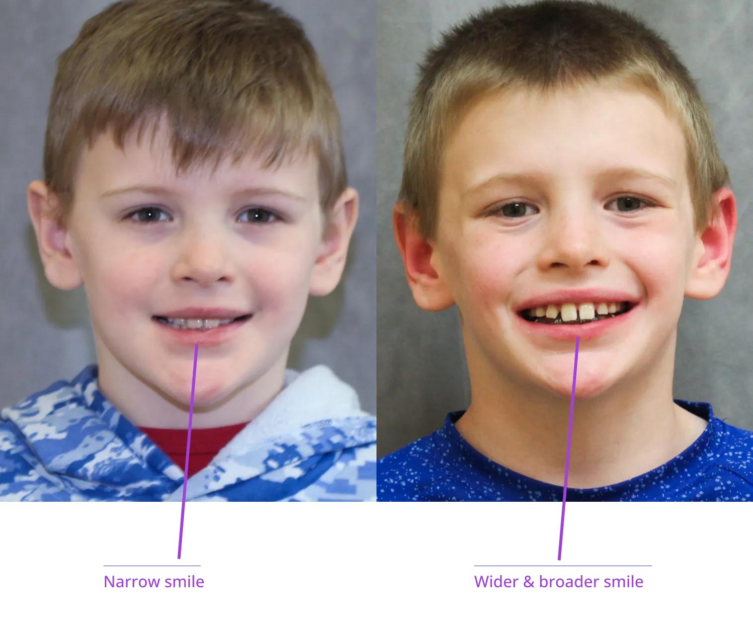 The image shows two young boys with different facial expressions, each labeled with text indicating 'narrow smile' on the left and 'wide & broader smile' on the right, highlighting the difference between their smiles.