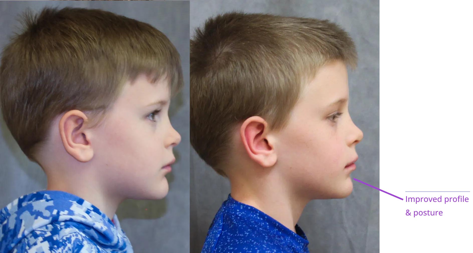 The image shows three side-by-side photographs of a young boy with a growth on his face, labeled with annotations indicating different stages of treatment or progression.