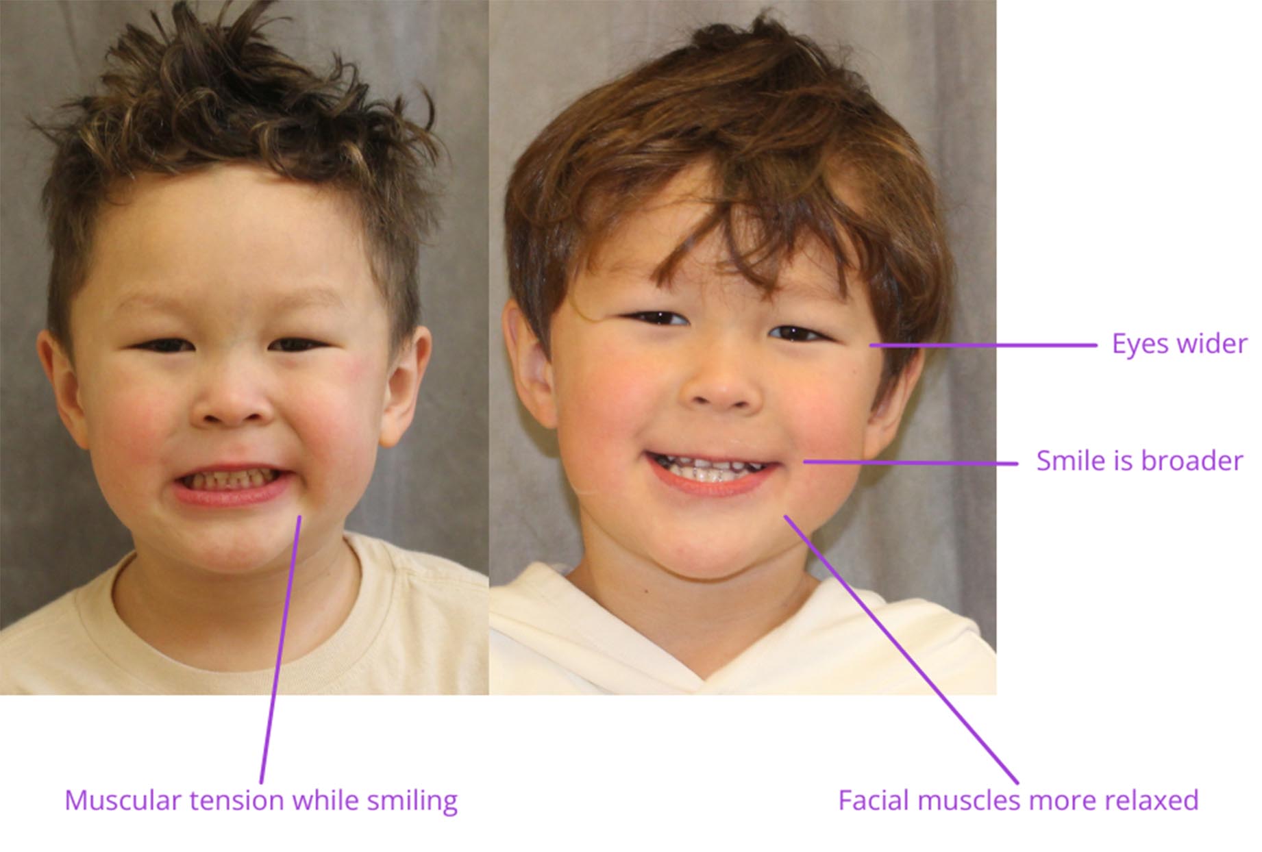 The image shows two photos side by side of a child with a caption detailing physical changes before and after treatment, highlighting facial muscles and tension relief.