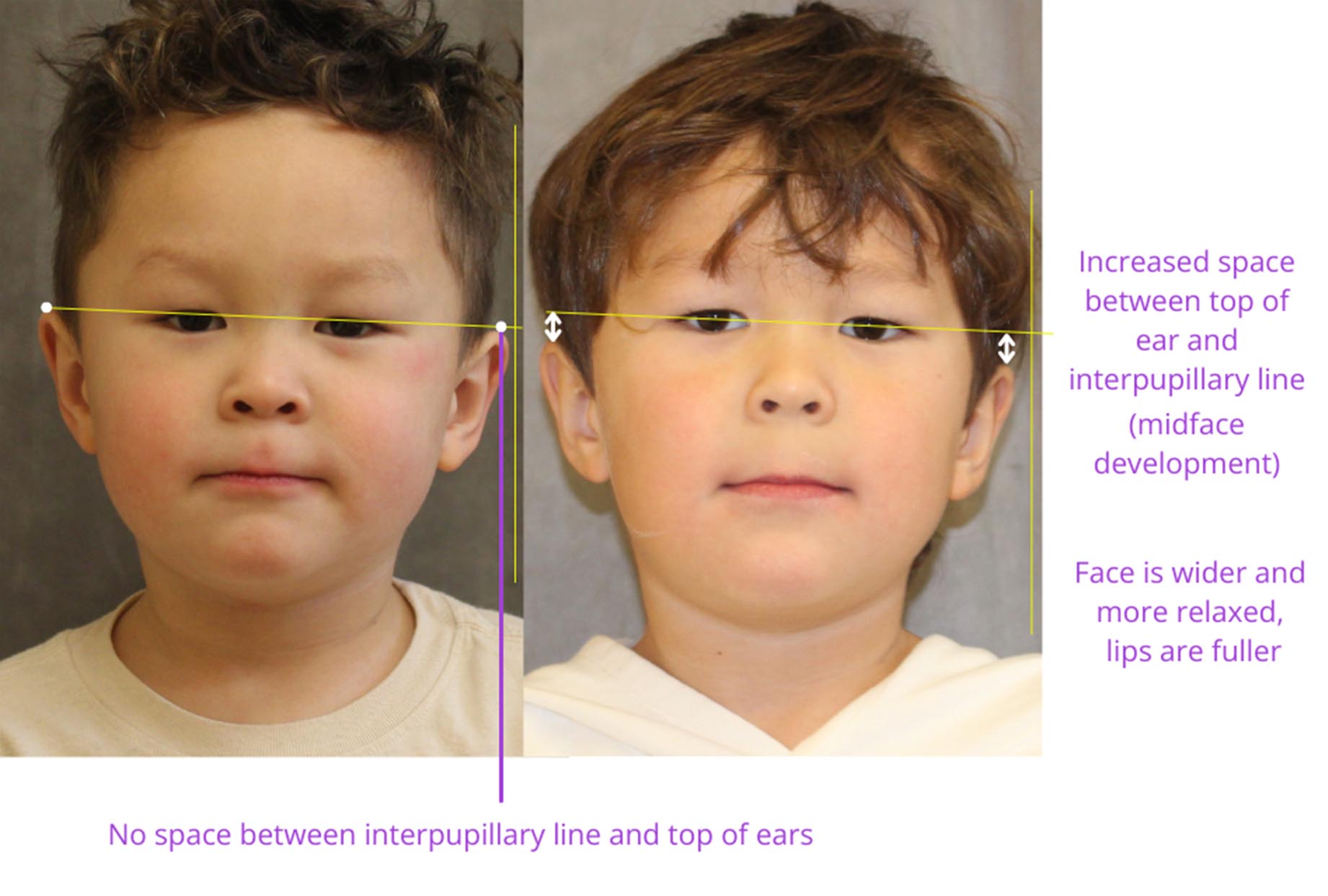 The image shows two side-by-side photographs of a person's face with text overlaying the comparison, indicating an alteration between the top and bottom images, likely for illustrative purposes related to cosmetic surgery or facial changes.