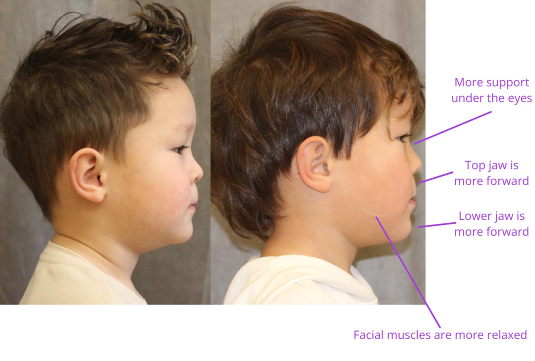 The image displays a side-by-side comparison of two different hairstyles on a young person, with annotations indicating the names of the styles and the facial muscles involved.