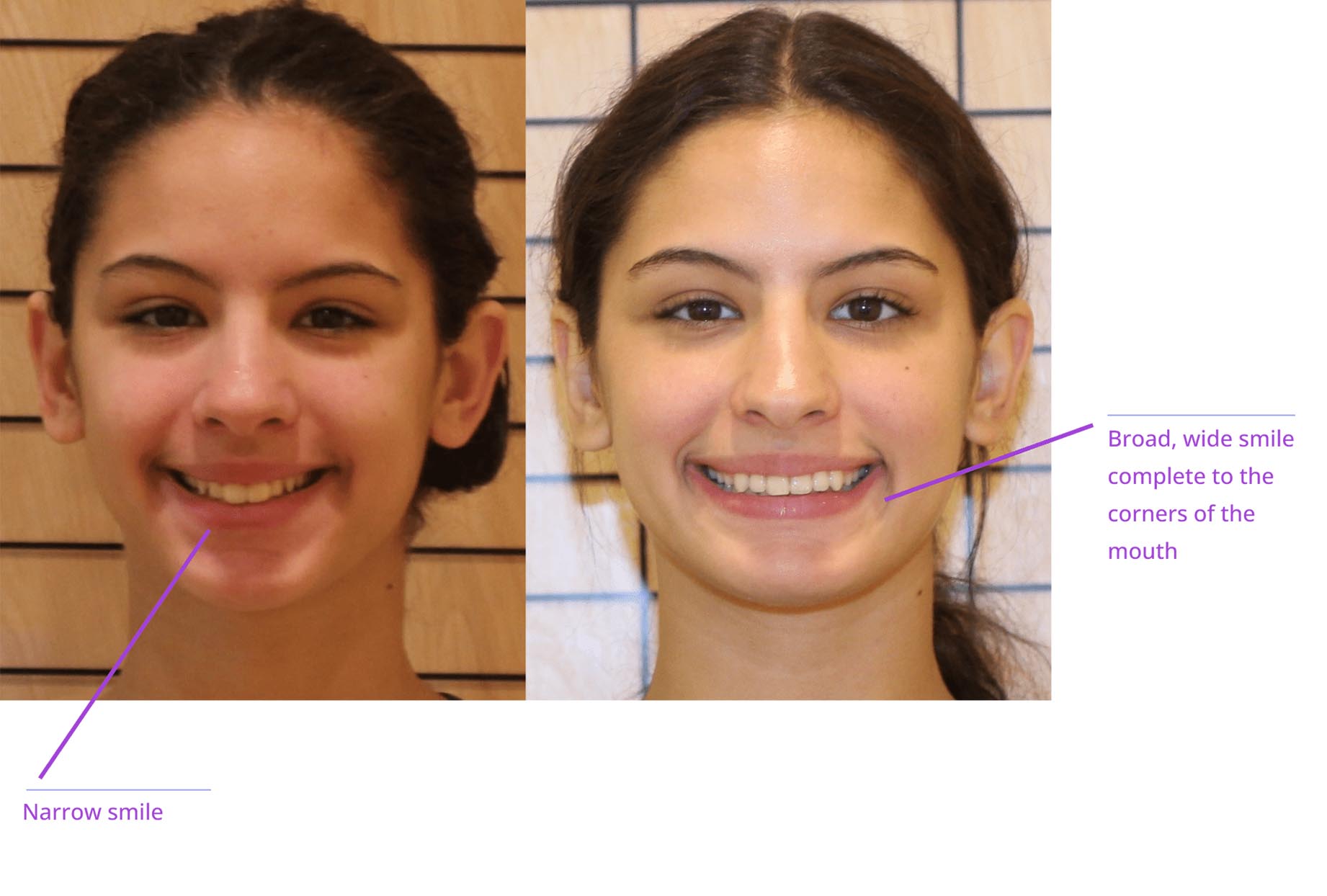 The image shows a side-by-side comparison of two photographs of a person's face with annotations indicating cosmetic dental work, labeled 'before' and 'after.
