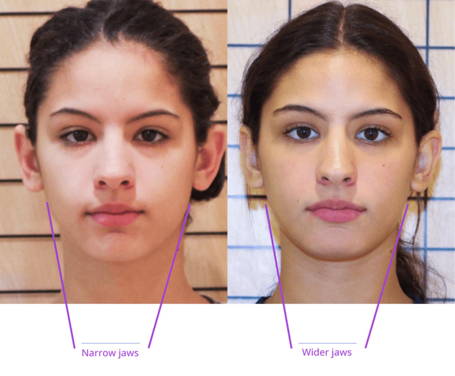 The image displays two side-by-side photographs of a person's face with measurements labeled: 'narrow jaws,' 'wide jaws.