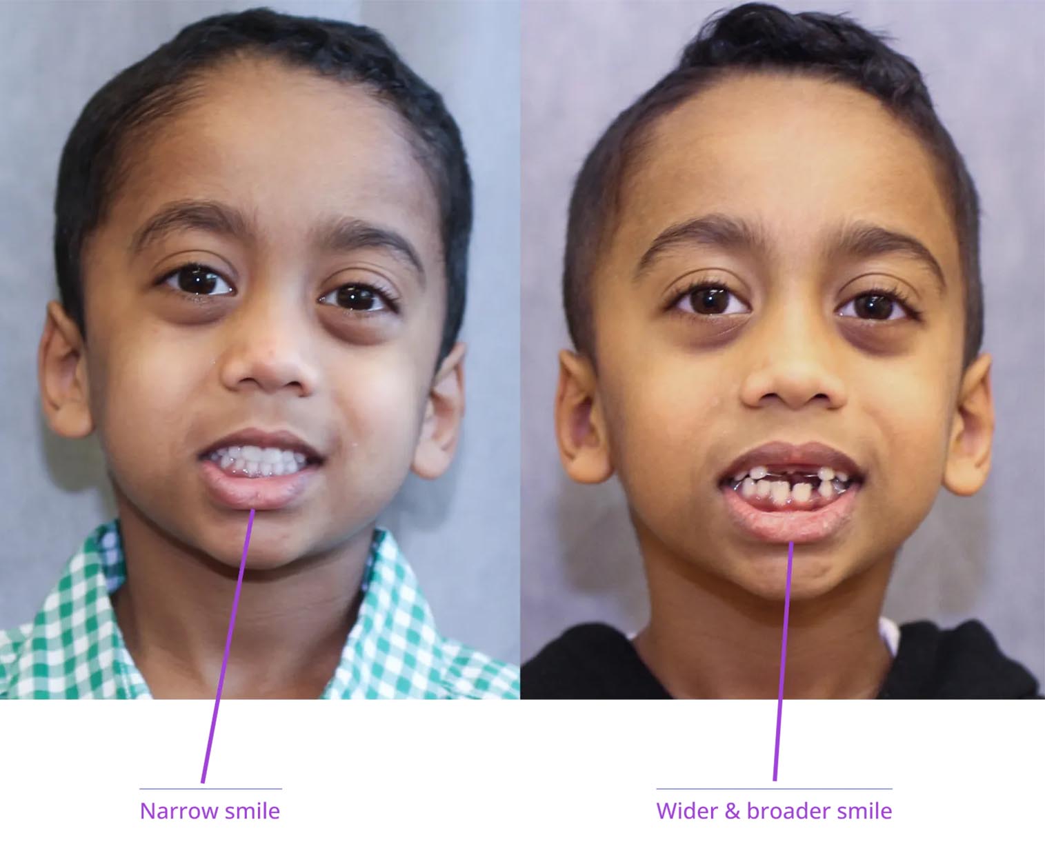 The image shows two side-by-side photographs of a young individual before and after dental treatment, highlighting the transformation from a wide smile to a broader one.