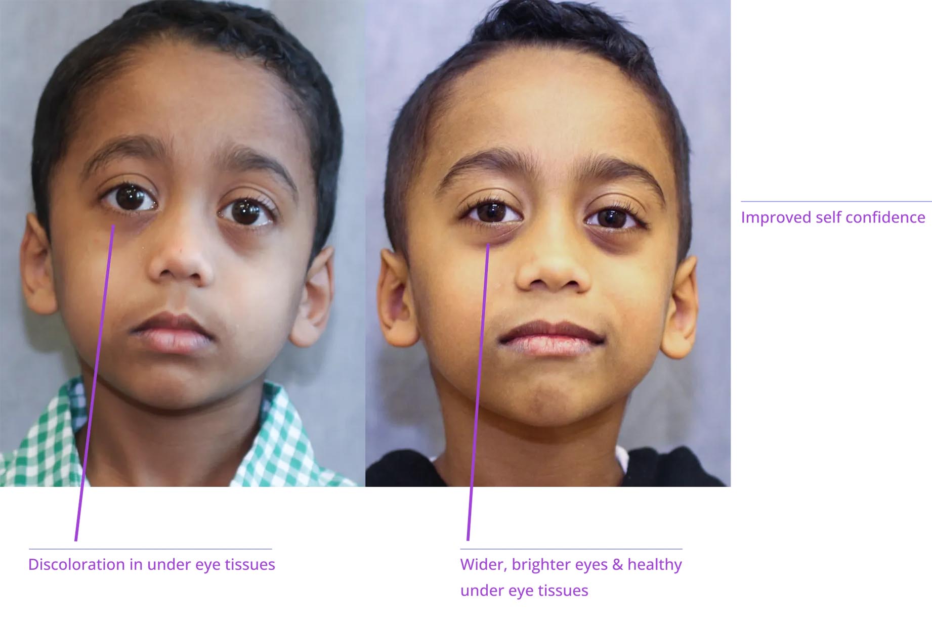 The image features two children with distinct facial expressions. One child has a neutral expression while the other appears to have a slight smile. Both children are shown from the chest up, and their faces are marked with annotations indicating different areas of interest, such as 'discoloration under eye,' 'brightness/darkness,' and 'eye health.' The image is likely used for educational or medical purposes to discuss skin conditions or treatments.