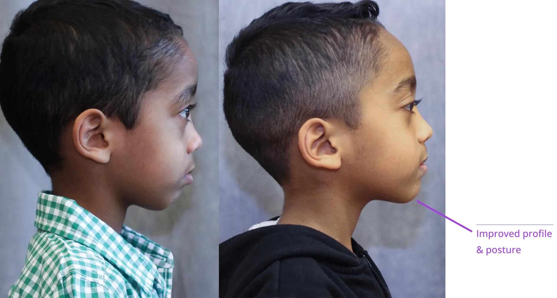 The image displays two side-by-side photographs of a person with a visible profile change over time, showcasing a transformation from one hairstyle to another.