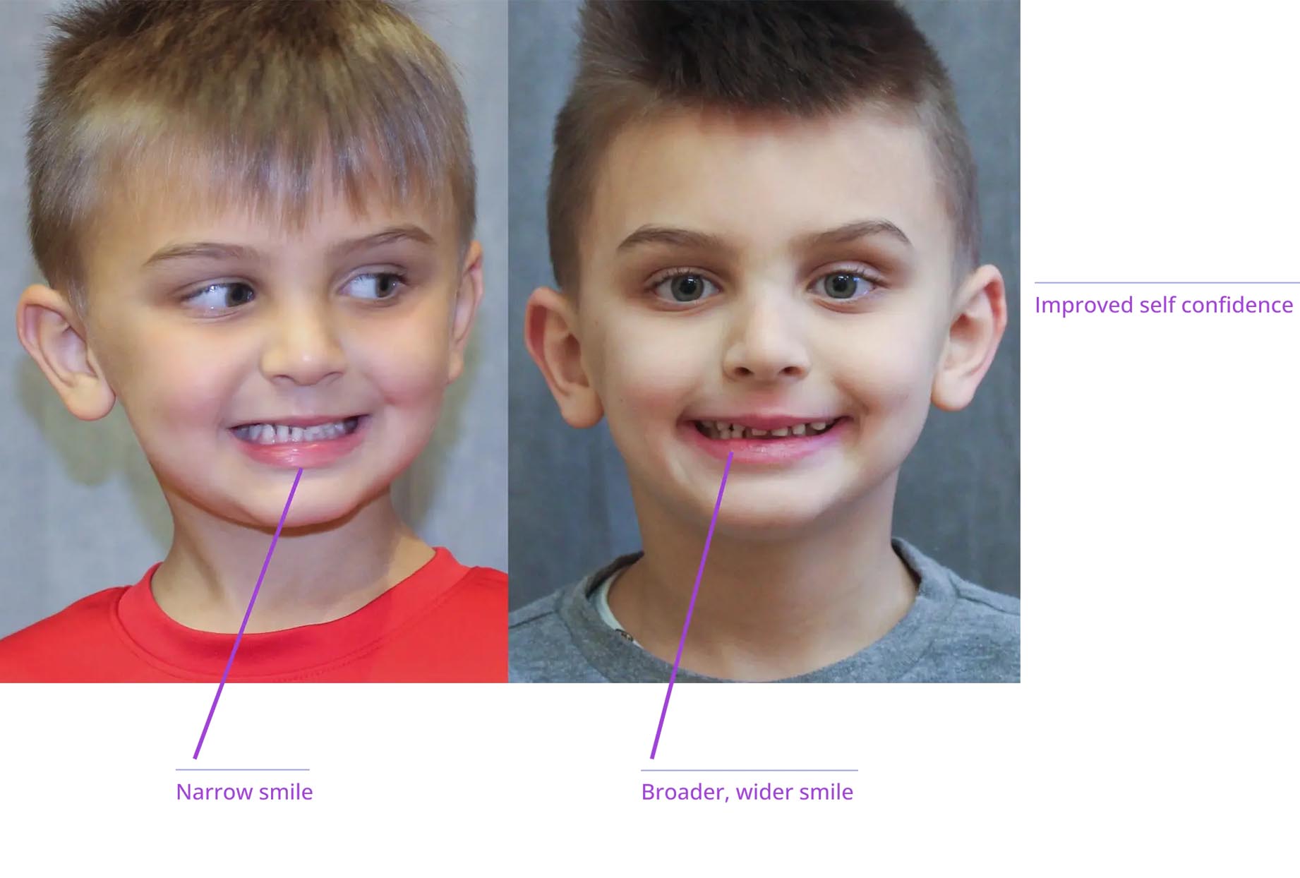The image shows two photographs of a young boy with a wide smile, displaying his teeth and braces. The top photo shows him with a more pronounced smile, while the bottom photo shows a similar expression but without braces.