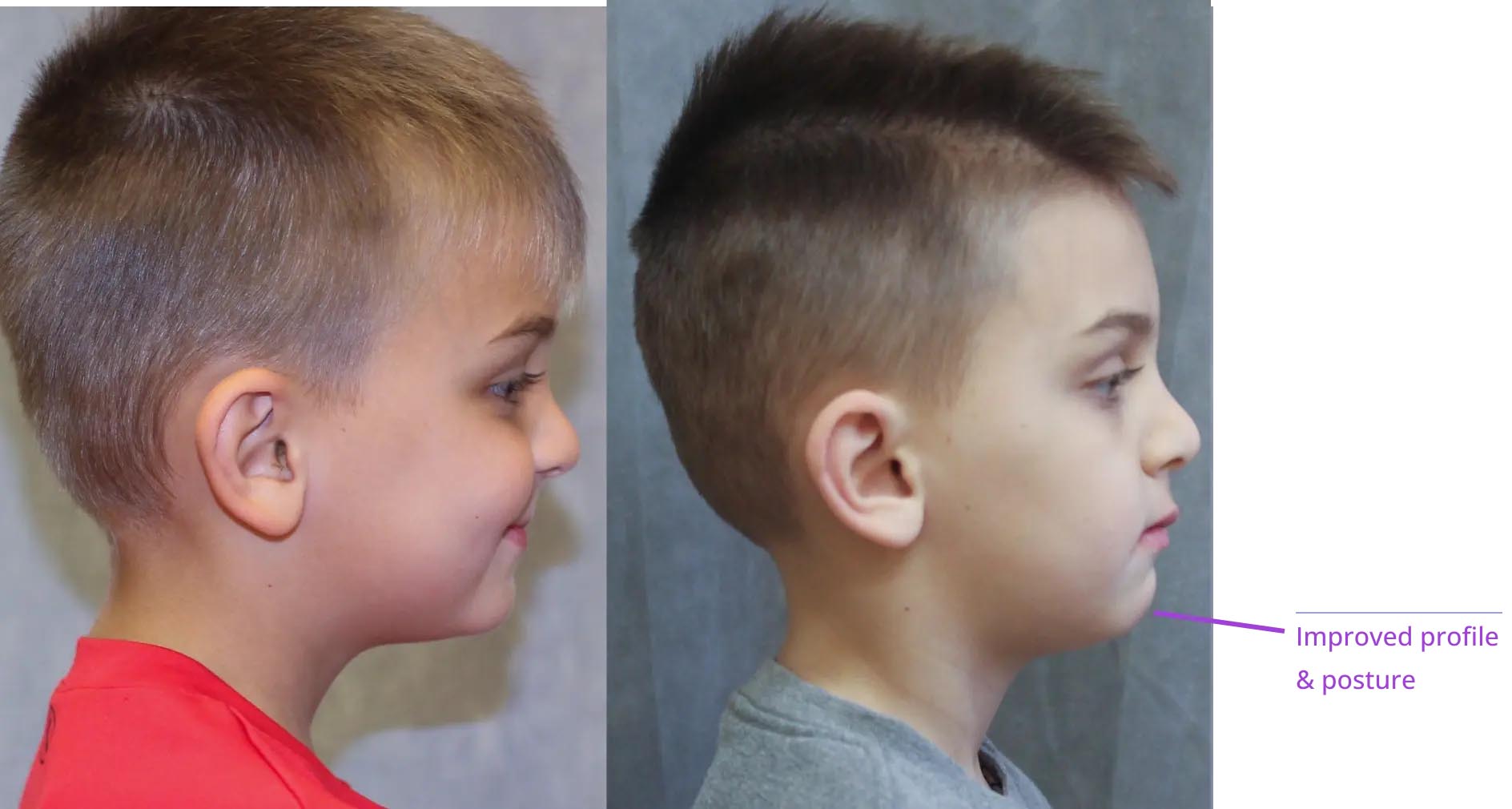 The image shows two side-by-side photographs of a young boy with a shaved head, displaying different hairstyles.