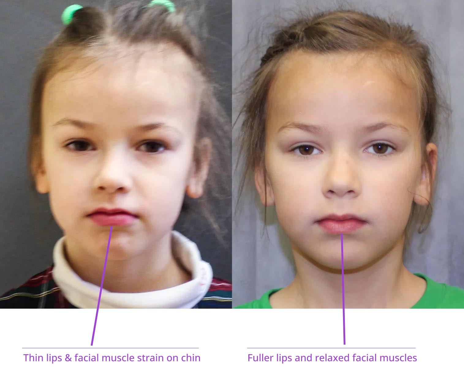 The image shows two photographs side by side of a young girl with facial features marked to indicate areas of muscle strain, thinning lips, fullness on the chin, and relaxed muscles around her eyes and forehead.