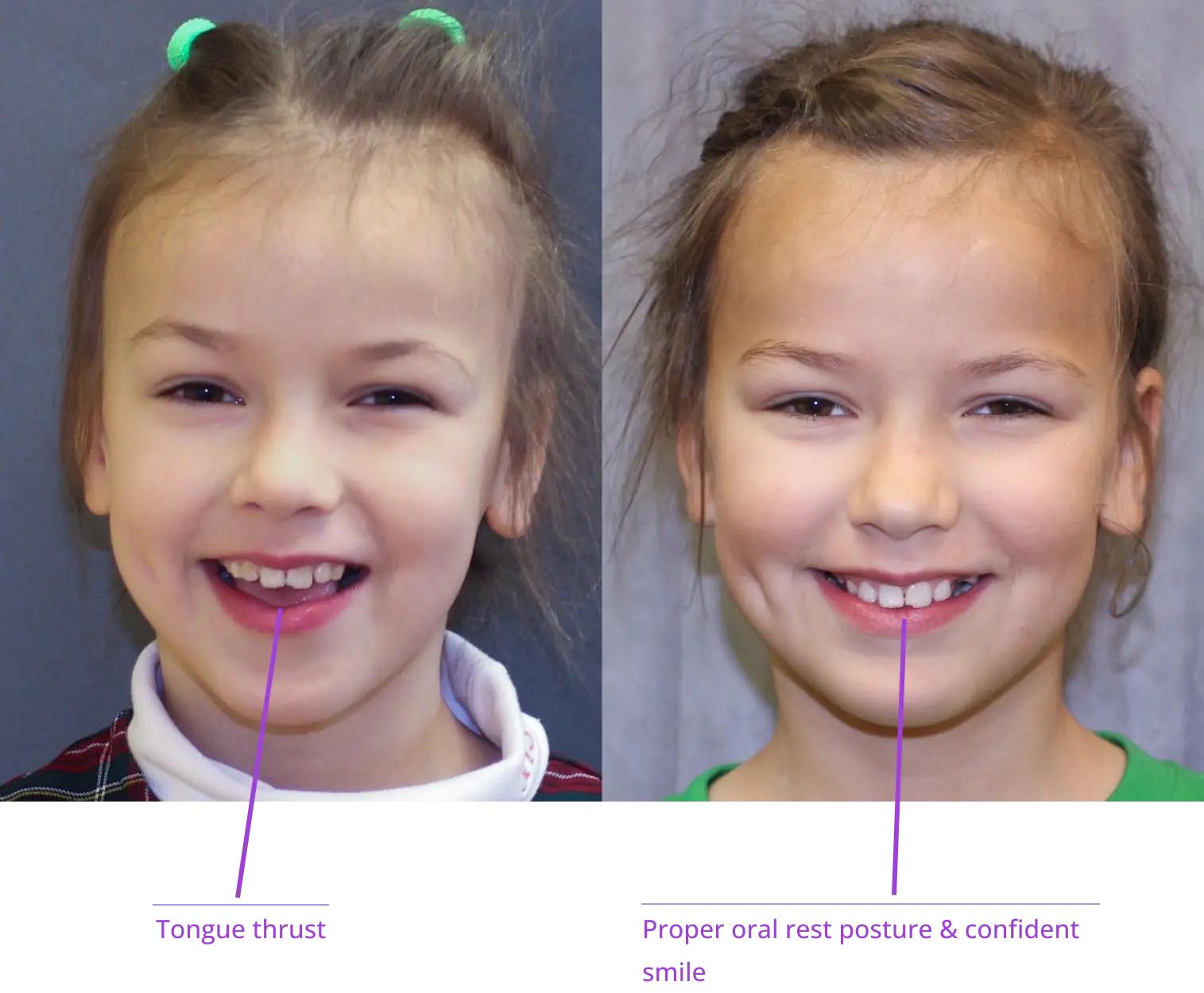 The image shows two individuals with different facial expressions, one smiling and the other with a neutral expression, both with their mouths open, displaying teeth and tongue.