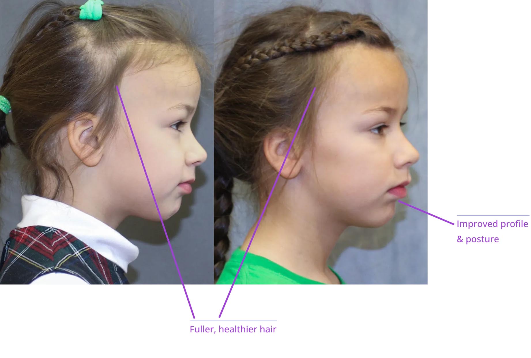The image shows a side-by-side comparison of a person's profile before and after a cosmetic procedure, highlighting the results with annotations indicating improvements to the hair, eyebrows, and overall appearance.