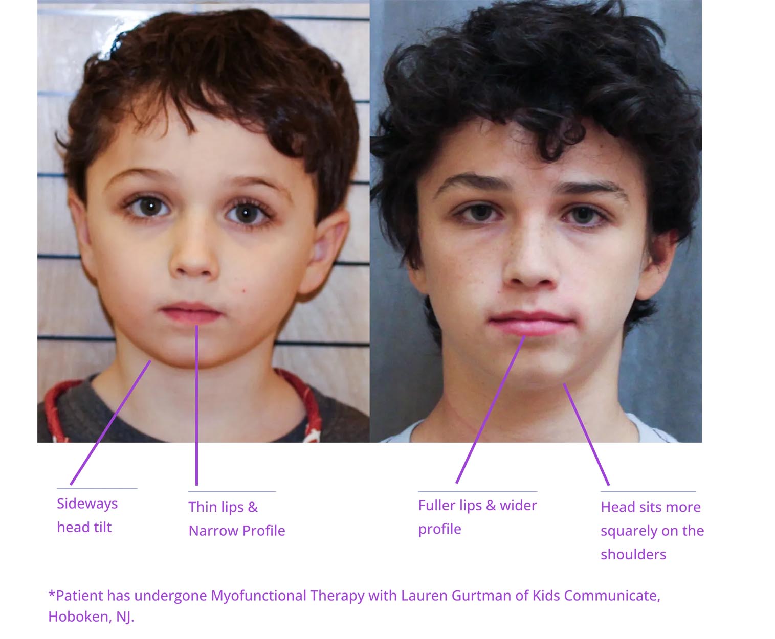 The image shows two side-by-side photographs of a young boy with a medical condition, highlighting the results of a treatment or procedure, with annotations pointing out specific features of his facial appearance before and after the treatment.