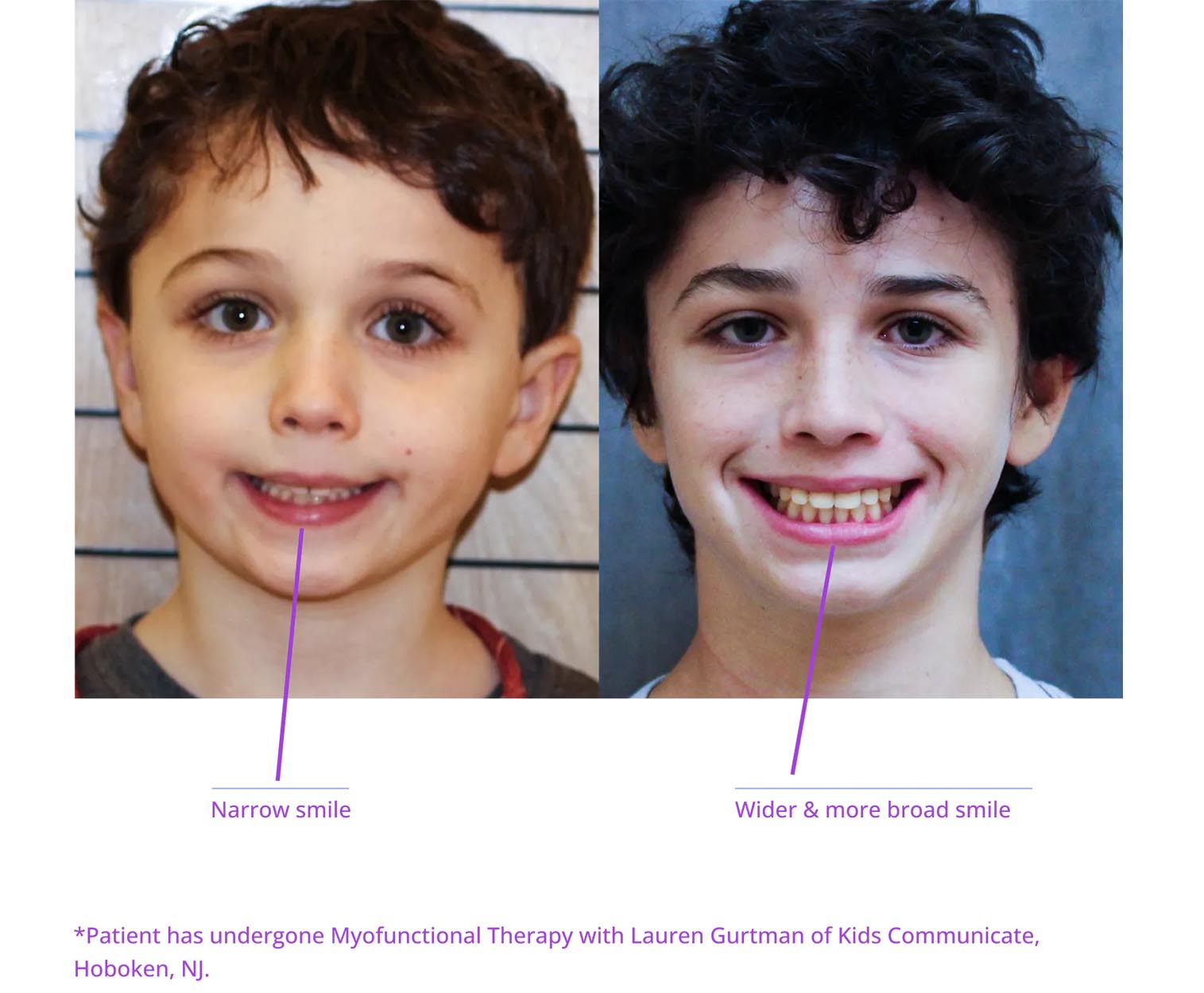The image shows two photographs side by side: on the left, a young boy with a wide smile; on the right, an adult male with a similar facial expression, both with text labels indicating their age ranges and the presence of 'My Functional Therapy' written beneath them, suggesting a before-and-after comparison.