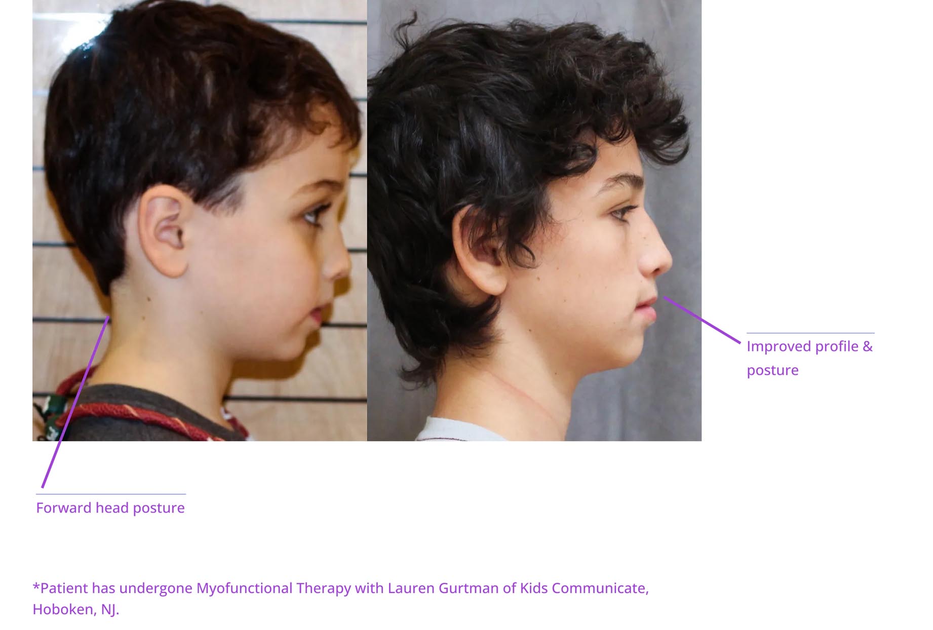 The image displays two photographs side by side of a person's head with annotations indicating 'forward head posture' and 'profile view.