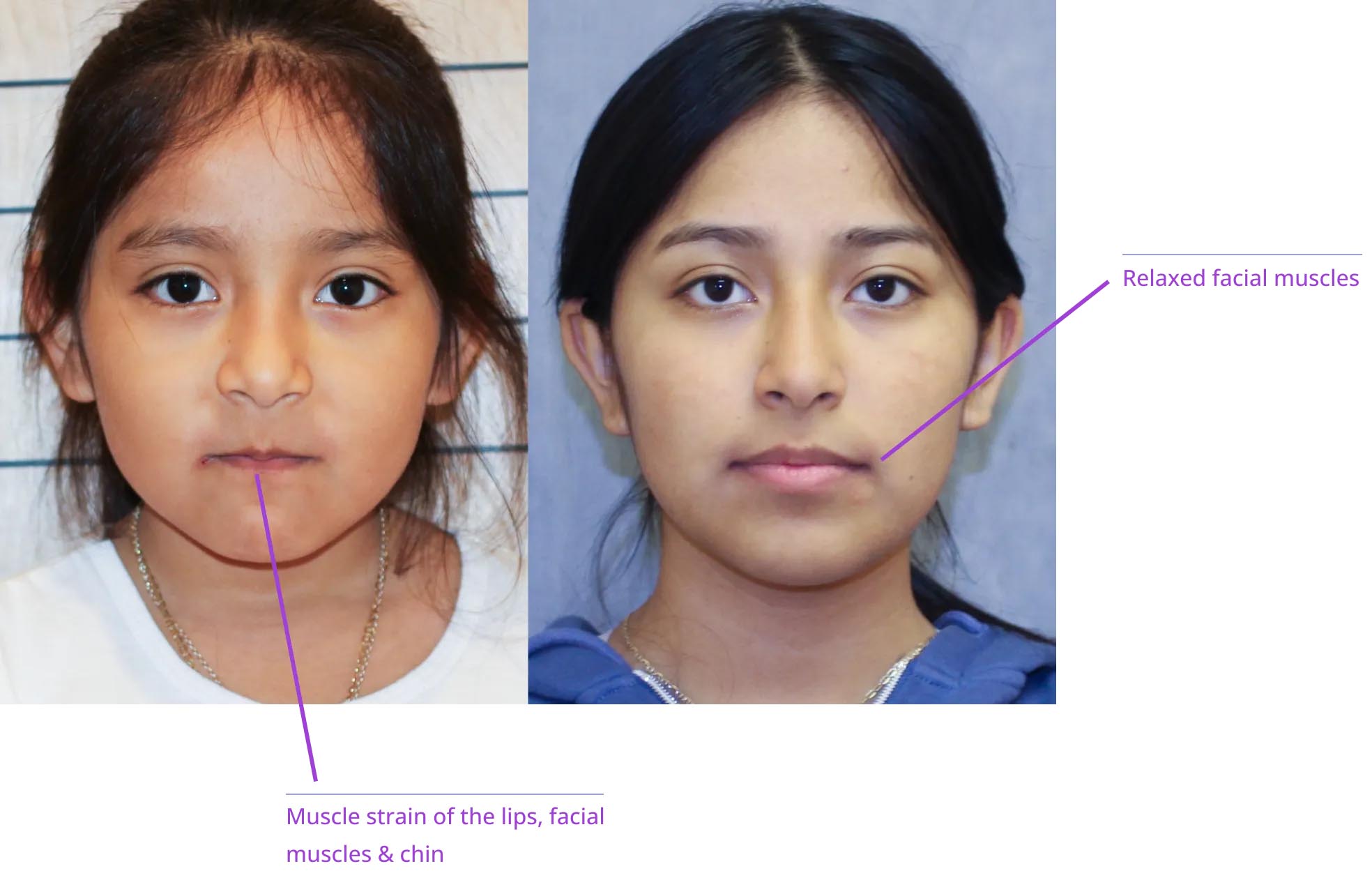 The image displays two side-by-side photographs: on the left, there's a close-up of a child's face with annotations pointing out facial muscles and features; on the right, there's a photo of a woman's face with similar annotations highlighting her facial muscles and structure.