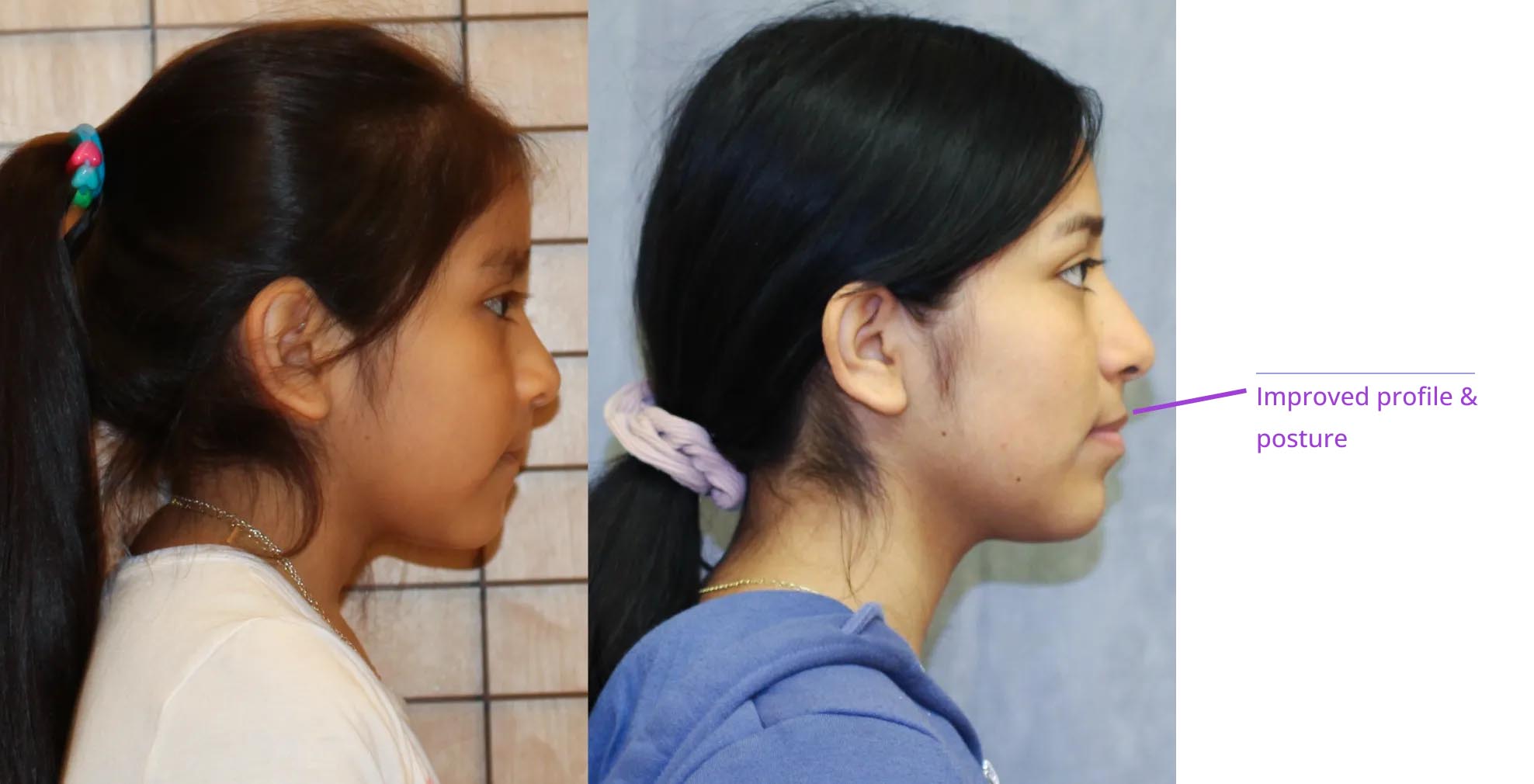 The image shows two side-by-side photos of a person before and after cosmetic dental work, with annotations pointing out the improvements made to the teeth.