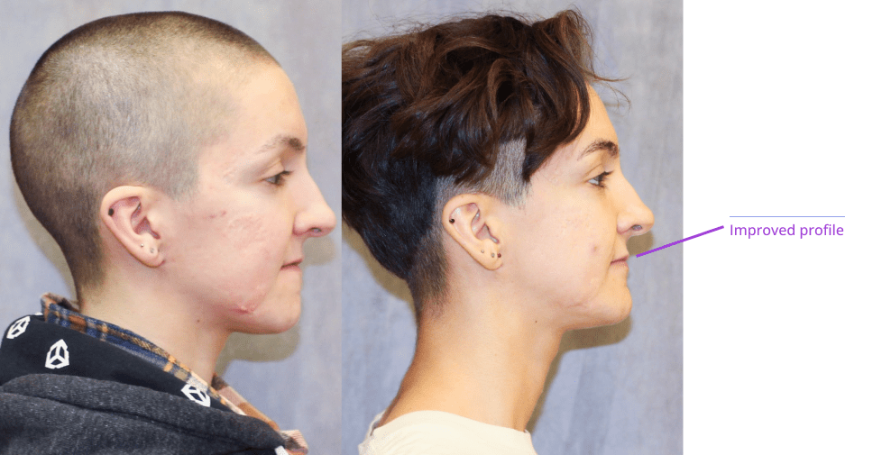 The image shows a person with a shaved head undergoing a medical treatment or procedure, specifically related to hair loss or transplant, as indicated by the visible scalp and the presence of a device or apparatus on their head.