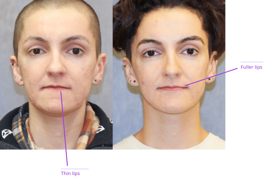 Two side-by-side images of a person with facial hair, showcasing before and after cosmetic treatments such as botox and fillers.